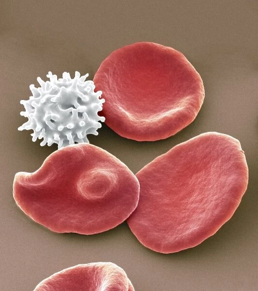 Healthy and crenated red blood cells, SEM