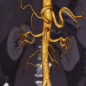 Abdominal aorta, 3D CT scan F006 / 9101