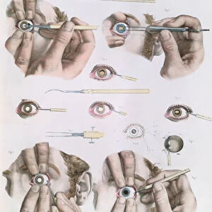 Operation on a eye, plate from Traite Complet de l Anatomie de l Homme